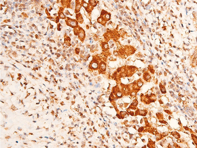 CHEK1 / CHK1 Antibody - 1:100 staining human lung carcinoma tissue by IHC-P. The tissue was formaldehyde fixed and a heat mediated antigen retrieval step in citrate buffer was performed. The tissue was then blocked and incubated with the antibody for 1.5 hours at 22°C. An HRP conjugated goat anti-rabbit antibody was used as the secondary.
