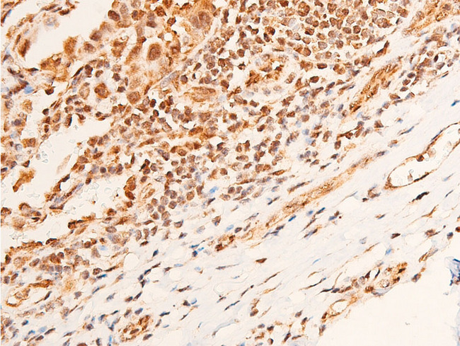CHEK1 / CHK1 Antibody - 1:100 staining human Cholangio-carcinoma tissue by IHC-P. The tissue was formaldehyde fixed and a heat mediated antigen retrieval step in citrate buffer was performed. The tissue was then blocked and incubated with the antibody for 1.5 hours at 22°C. An HRP conjugated goat anti-rabbit antibody was used as the secondary.