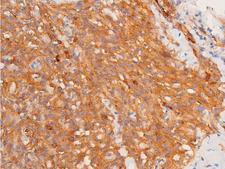 CHEK1 / CHK1 Antibody - 1:100 staining human lymphoid tissue by IHC-P. The tissue was formaldehyde fixed and a heat mediated antigen retrieval step in citrate buffer was performed. The tissue was then blocked and incubated with the antibody for 1.5 hours at 22°C. An HRP conjugated goat anti-rabbit antibody was used as the secondary.
