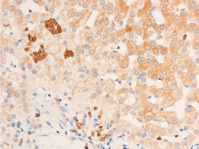 CHEK1 / CHK1 Antibody - 1:100 staining human vascular carcinoma tissue by IHC-P. The tissue was formaldehyde fixed and a heat mediated antigen retrieval step in citrate buffer was performed. The tissue was then blocked and incubated with the antibody for 1.5 hours at 22°C. An HRP conjugated goat anti-rabbit antibody was used as the secondary.