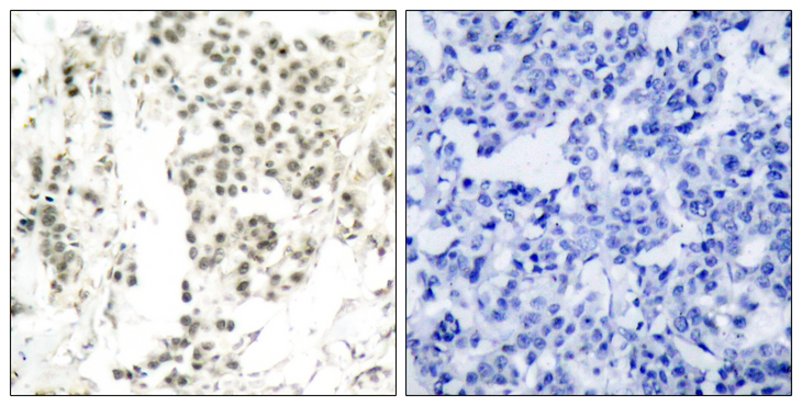 CHEK1 / CHK1 Antibody - Immunohistochemistry analysis of paraffin-embedded human breast carcinoma, using Chk1 (Phospho-Ser345) Antibody. The picture on the right is blocked with the phospho peptide.