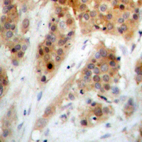 CHEK1 / CHK1 Antibody - Immunohistochemical analysis of CHK1 (pS345) staining in human breast cancer formalin fixed paraffin embedded tissue section. The section was pre-treated using heat mediated antigen retrieval with sodium citrate buffer (pH 6.0). The section was then incubated with the antibody at room temperature and detected using an HRP conjugated compact polymer system. DAB was used as the chromogen. The section was then counterstained with hematoxylin and mounted with DPX.