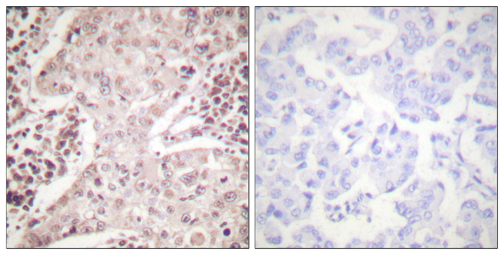 CHEK2 / CHK2 Antibody - Immunohistochemistry analysis of paraffin-embedded human breast carcinoma, using Chk2 Antibody. The picture on the right is blocked with the synthesized peptide.