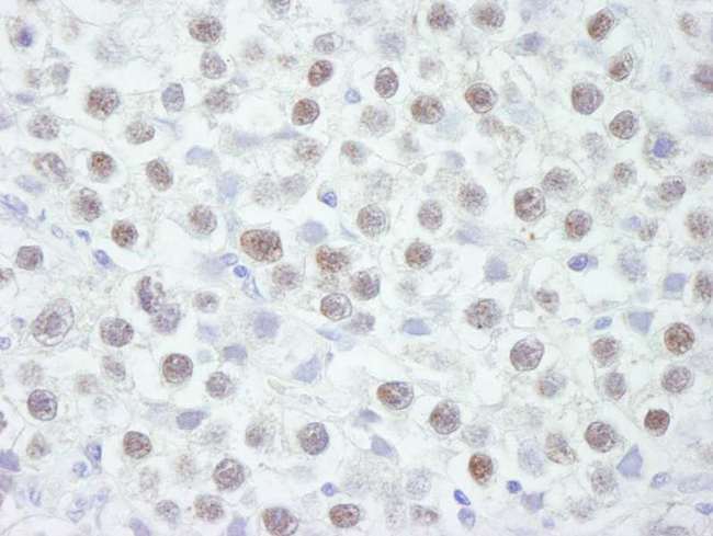 CHEK2 / CHK2 Antibody - Detection of Human CHK2 by Immunohistochemistry. Sample: FFPE section of human seminoma. Antibody: Affinity purified rabbit anti-CHK2 used at a dilution of 1:250. Detection: DAB.