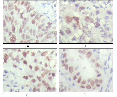 CHEK2 / CHK2 Antibody - IHC of paraffin-embedded human lung carcinoma (A), liver carcinoma (B), breast carcinoma (C) and kidney carcinoma (D), showing nuclear localization with DAB staining using CHK2 mouse monoclonal antibody.