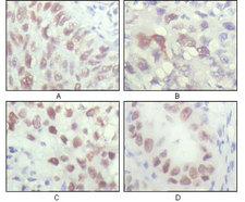 CHEK2 / CHK2 Antibody - IHC of paraffin-embedded human lung carcinoma (A), liver carcinoma (B), breast carcinoma (C) and kidney carcinoma (D), showing nuclear localization with DAB staining using CHK2 mouse monoclonal antibody.