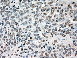 CHEK2 / CHK2 Antibody - IHC of paraffin-embedded Adenocarcinoma of ovary tissue using anti-CHEK2 mouse monoclonal antibody. (Dilution 1:50).