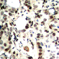 CHEK2 / CHK2 Antibody - Immunohistochemical analysis of CHK2 staining in human breast cancer formalin fixed paraffin embedded tissue section. The section was pre-treated using heat mediated antigen retrieval with sodium citrate buffer (pH 6.0). The section was then incubated with the antibody at room temperature and detected using an HRP conjugated compact polymer system. DAB was used as the chromogen. The section was then counterstained with hematoxylin and mounted with DPX.