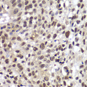 CHEK2 / CHK2 Antibody - Immunohistochemistry of paraffin-embedded human lung cancer tissue.