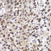 CHEK2 / CHK2 Antibody - Immunohistochemistry of paraffin-embedded human lung cancer using CHEK2 antibody at dilution of 1:100 (40x lens).
