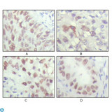 CHEK2 / CHK2 Antibody - Immunohistochemistry (IHC) analysis of paraffin-embedded Human Lung carcinoma (A), liver carcinoma (B), breast carcinoma (C) and kiney carcinoma (D), showing nuclear localization with DAB staining using Chk2 Monoclonal Antibody.