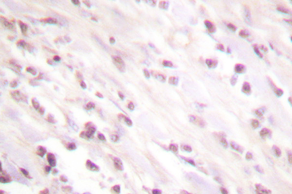 CHEK2 / CHK2 Antibody - IHC of Chk2 (M381) pAb in paraffin-embedded human breast carcinoma tissue.