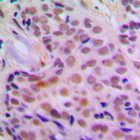CHEK2 / CHK2 Antibody - Immunohistochemical analysis of CHK2 staining in human breast cancer formalin fixed paraffin embedded tissue section. The section was pre-treated using heat mediated antigen retrieval with sodium citrate buffer (pH 6.0). The section was then incubated with the antibody at room temperature and detected using an HRP conjugated compact polymer system. DAB was used as the chromogen. The section was then counterstained with hematoxylin and mounted with DPX.