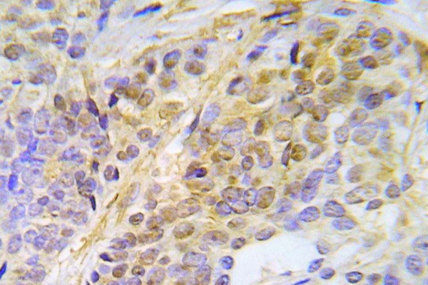 CHEK2 / CHK2 Antibody - IHC of p-CHK2 (T387) pAb in paraffin-embedded human lung adenocarcinoma tissue.