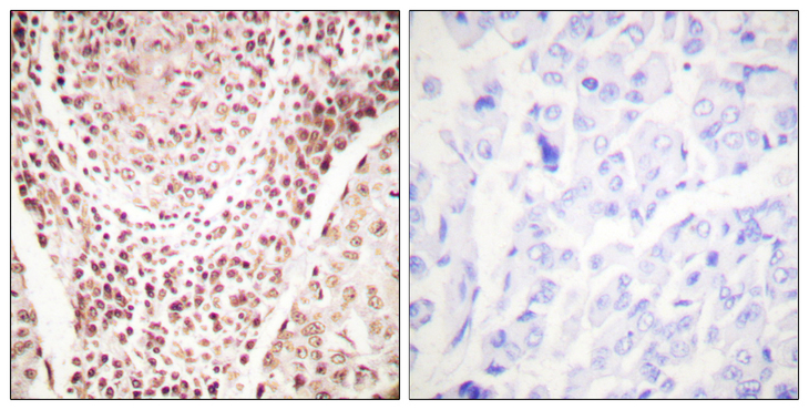 CHEK2 / CHK2 Antibody - Immunohistochemistry analysis of paraffin-embedded human breast carcinoma, using Chk2 (Phospho-Thr387) Antibody. The picture on the right is blocked with the phospho peptide.