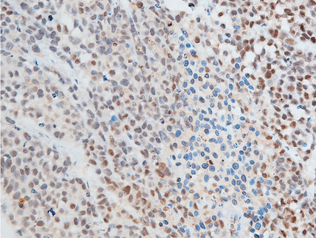 CHEK2 / CHK2 Antibody - 1:100 staining rat carcinoma tissue by IHC-P. The tissue was formaldehyde fixed and a heat mediated antigen retrieval step in citrate buffer was performed. The tissue was then blocked and incubated with the antibody for 1.5 hours at 22°C. An HRP conjugated goat anti-rabbit antibody was used as the secondary.