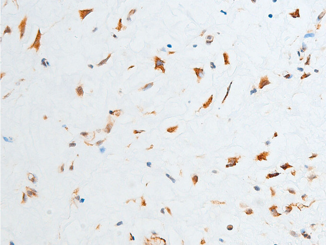 CHEK2 / CHK2 Antibody - 1:100 staining human glioma tissue by IHC-P. The tissue was formaldehyde fixed and a heat mediated antigen retrieval step in citrate buffer was performed. The tissue was then blocked and incubated with the antibody for 1.5 hours at 22°C. An HRP conjugated goat anti-rabbit antibody was used as the secondary.