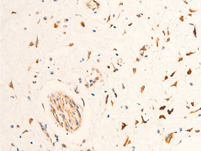 CHEK2 / CHK2 Antibody - 1:100 staining human glioma tissue by IHC-P. The tissue was formaldehyde fixed and a heat mediated antigen retrieval step in citrate buffer was performed. The tissue was then blocked and incubated with the antibody for 1.5 hours at 22°C. An HRP conjugated goat anti-rabbit antibody was used as the secondary.