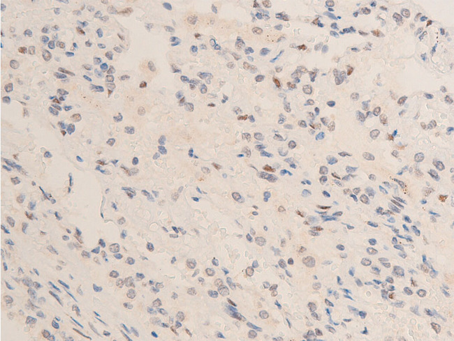 CHEK2 / CHK2 Antibody - 1:100 staining human TB tissue by IHC-P. The tissue was formaldehyde fixed and a heat mediated antigen retrieval step in citrate buffer was performed. The tissue was then blocked and incubated with the antibody for 1.5 hours at 22°C. An HRP conjugated goat anti-rabbit antibody was used as the secondary.