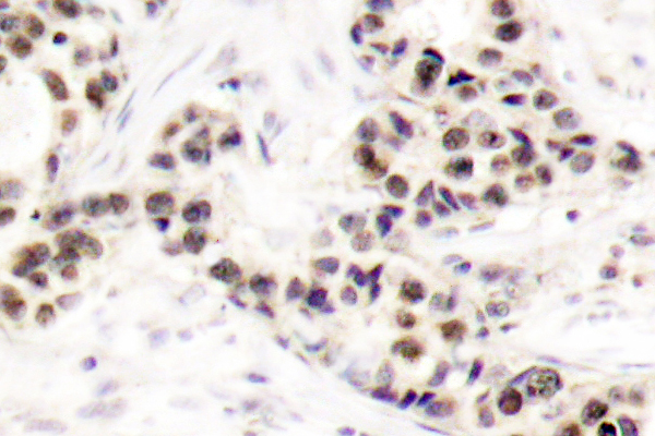 CHEK2 / CHK2 Antibody - IHC of Chk2 (S62) pAb in paraffin-embedded Human breast carcinoma tissue.