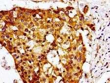 CHEMR23 / CMKLR1 Antibody - Immunohistochemistry image of paraffin-embedded human breast cancer at a dilution of 1:100