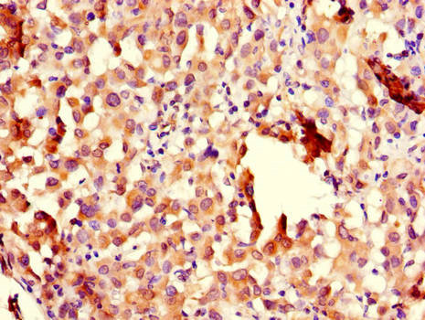 CHFR Antibody - Immunohistochemistry of paraffin-embedded human lung cancer using CHFR Antibody at dilution of 1:100