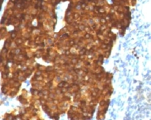 CHGA / Chromogranin A Antibody - Formalin-paraffin human pheochromocytoma stained with Chromogranin A antibody (bGRAN9.  This image was taken for the unmodified form of this product. Other forms have not been tested.