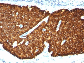 CHGA / Chromogranin A Antibody - Formalin-fixed, paraffin-embedded human pheochromocytoma stained with Chromogranin A antibody (CGA/413).  This image was taken for the unmodified form of this product. Other forms have not been tested.