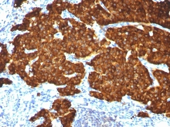 CHGA / Chromogranin A Antibody - Formalin-fixed, paraffin-embedded pheochromocytoma stained with Chromogranin A antibody cocktail.  This image was taken for the unmodified form of this product. Other forms have not been tested.