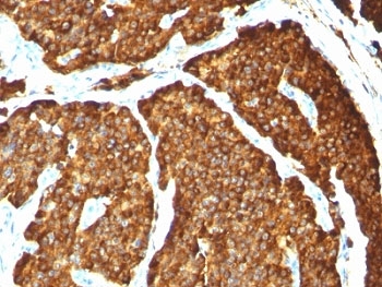 CHGA / Chromogranin A Antibody - Formalin-paraffin human pheochromocytoma stained with Chromogranin A antibody (CHGA/777).  This image was taken for the unmodified form of this product. Other forms have not been tested.