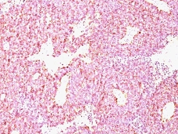 CHGA / Chromogranin A Antibody - Formalin-paraffin human SC lung carcinoma stained with Chromogranin A antibody (CHGA/798).  This image was taken for the unmodified form of this product. Other forms have not been tested.