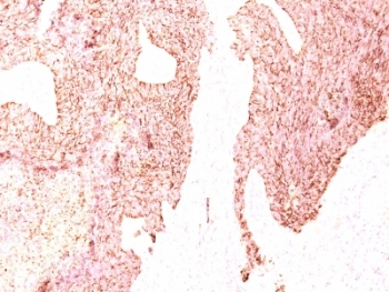 CHGA / Chromogranin A Antibody - Formalin-fixed, paraffin-embedded human small cell lung carcinoma stained with Chromogranin A antibody (SPM339).  This image was taken for the unmodified form of this product. Other forms have not been tested.