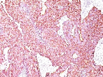 CHGA / Chromogranin A Antibody - Formalin-fixed, paraffin-embedded human small cell lung carcinoma stained with Chromogranin A antibody (SPM585).  This image was taken for the unmodified form of this product. Other forms have not been tested.
