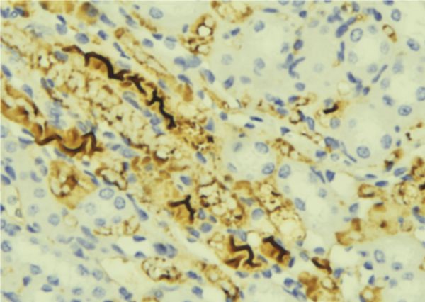 CHI3L1 / YKL-40 Antibody - 1:100 staining mouse liver tissue by IHC-P. The sample was formaldehyde fixed and a heat mediated antigen retrieval step in citrate buffer was performed. The sample was then blocked and incubated with the antibody for 1.5 hours at 22°C. An HRP conjugated goat anti-rabbit antibody was used as the secondary.
