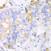 CHIA / Amcase Antibody - Immunohistochemistry of paraffin-embedded human liver cancer tissue.