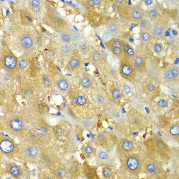 CHIA / Amcase Antibody - Immunohistochemistry of paraffin-embedded human liver injury tissue.