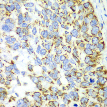 CHIA / Amcase Antibody - Immunohistochemistry of paraffin-embedded human esophageal cancer tissue.
