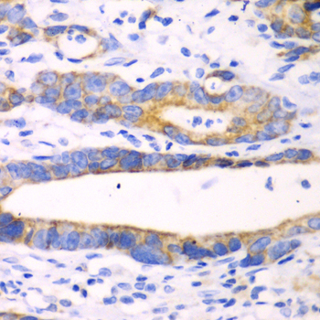 CHIA / Amcase Antibody - Immunohistochemistry of paraffin-embedded human gastric cancer tissue.