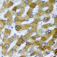 CHIA / Amcase Antibody - Immunohistochemical analysis of AMCase staining in human liver cancer formalin fixed paraffin embedded tissue section. The section was pre-treated using heat mediated antigen retrieval with sodium citrate buffer (pH 6.0). The section was then incubated with the antibody at room temperature and detected using an HRP conjugated compact polymer system. DAB was used as the chromogen. The section was then counterstained with hematoxylin and mounted with DPX.