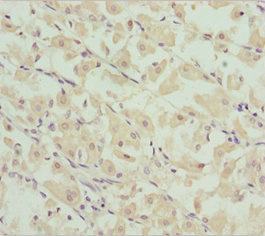 CHIC2 Antibody - Immunohistochemistry of paraffin-embedded human gastric cancer at dilution 1:100