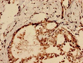 CHID1 Antibody - Immunohistochemistry analysis of human breast cancer using CHID1 Antibody at dilution of 1:100