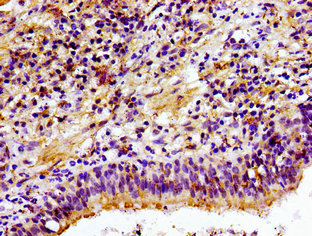 CHKA / CK / Choline Kinase Antibody - Immunohistochemistry image of paraffin-embedded human lung cancer at a dilution of 1:100