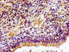 CHKA / CK / Choline Kinase Antibody - Immunohistochemistry image of paraffin-embedded human lung cancer at a dilution of 1:100
