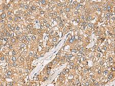 CHKA / CK / Choline Kinase Antibody - Immunohistochemistry of paraffin-embedded Human liver cancer tissue  using CHKA Polyclonal Antibody at dilution of 1:35(×200)