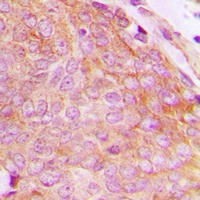 CHKB / CHKL Antibody - Immunohistochemical analysis of CHKB staining in human breast cancer formalin fixed paraffin embedded tissue section. The section was pre-treated using heat mediated antigen retrieval with sodium citrate buffer (pH 6.0). The section was then incubated with the antibody at room temperature and detected with HRP and DAB as chromogen. The section was then counterstained with hematoxylin and mounted with DPX.