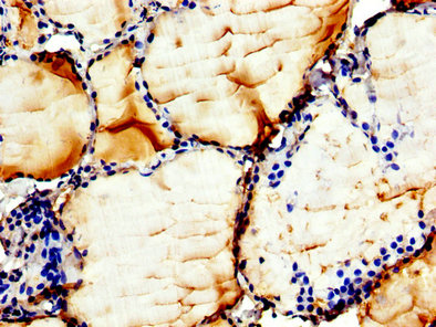 CHKB / CHKL Antibody - Immunohistochemistry image at a dilution of 1:300 and staining in paraffin-embedded human thyroid tissue performed on a Leica BondTM system. After dewaxing and hydration, antigen retrieval was mediated by high pressure in a citrate buffer (pH 6.0) . Section was blocked with 10% normal goat serum 30min at RT. Then primary antibody (1% BSA) was incubated at 4 °C overnight. The primary is detected by a biotinylated secondary antibody and visualized using an HRP conjugated SP system.