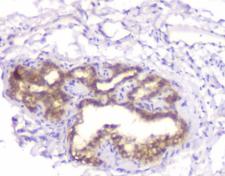 CHM / REP1 Antibody - IHC staining of FFPE human thyroid cancer with CHM antibody at 1ug/ml. HIER: boil tissue sections in pH6, 10mM citrate buffer, for 10-20 min and allow to cool before testing.