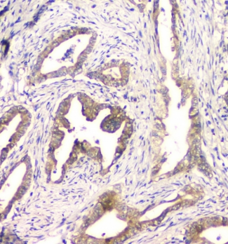 CHM / REP1 Antibody - IHC staining of FFPE human intestinal cancer with CHM antibody at 1ug/ml. HIER: boil tissue sections in pH6, 10mM citrate buffer, for 10-20 min and allow to cool before testing.