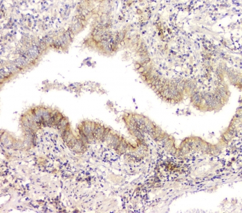 CHM / REP1 Antibody - IHC staining of FFPE human lung cancer with CHM antibody at 1ug/ml. HIER: boil tissue sections in pH6, 10mM citrate buffer, for 10-20 min and allow to cool before testing.