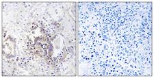 CHML Antibody - Peptide - + Immunohistochemistry analysis of paraffin-embedded human lung carcinoma tissue, using CHML antibody.